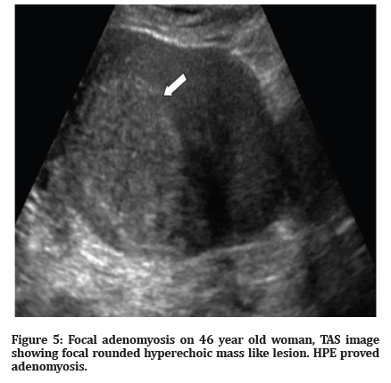 Medical-Dental-adenomyosis