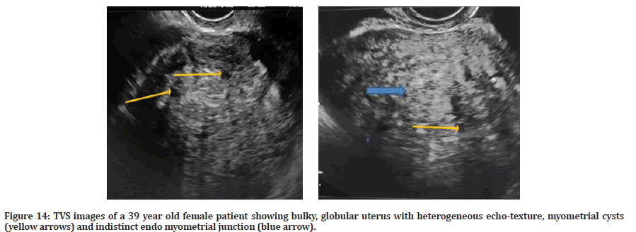 Evaluation of abnormal uterine bleeding in postmenopausal women