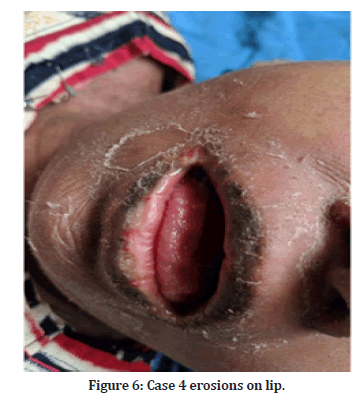 Medical-Dental-erosions