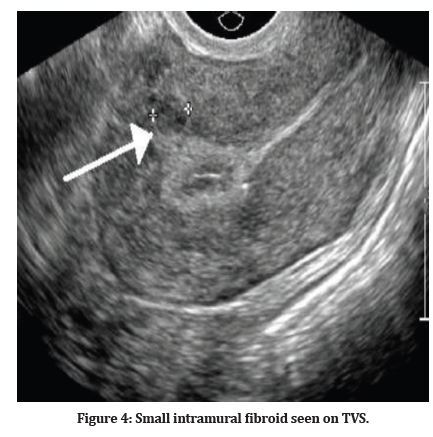 Medical-Dental-fibroid