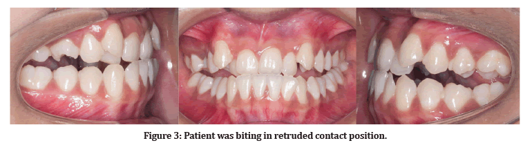 medical-dental-retruded