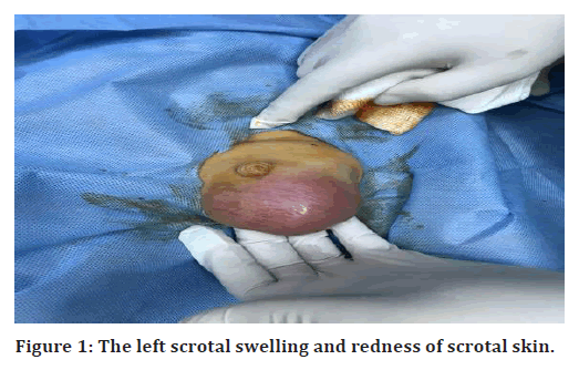 medical-dental-science-scrotal-swelling