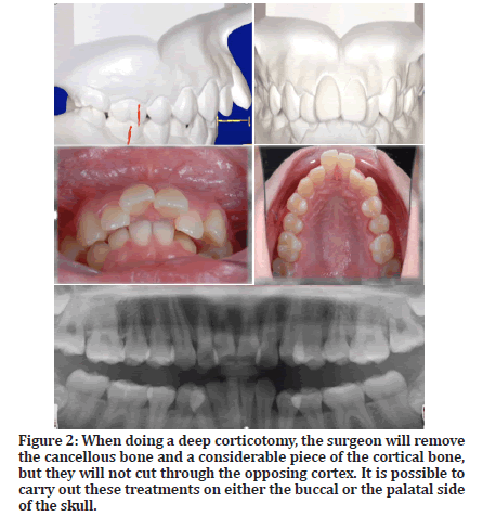 Medical-Dental-corticotomy