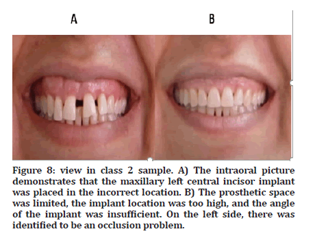 Medical-Dental-incisor