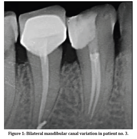 CBCT: 3D image with identification of the left bifid mandibular canal.