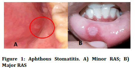 jrmds-Aphthous jrmds-Aphthous